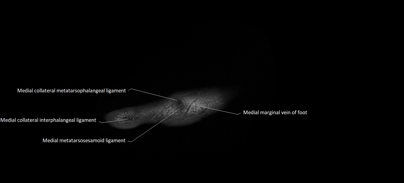 MRI foot sagittal labelled cross sectional anatomy image  1.webp